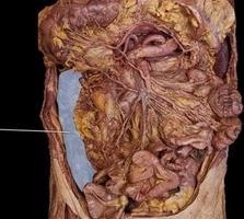 Which region of the colon is highlighted? a) descending b) sigmoid c) ascending d-example-1