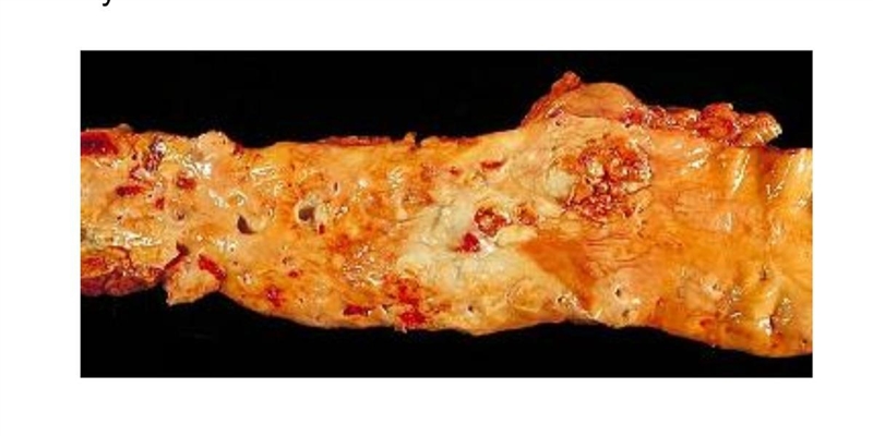 Atherosclerosis is a condition in which fatty materials accumulate in the arteries-example-1