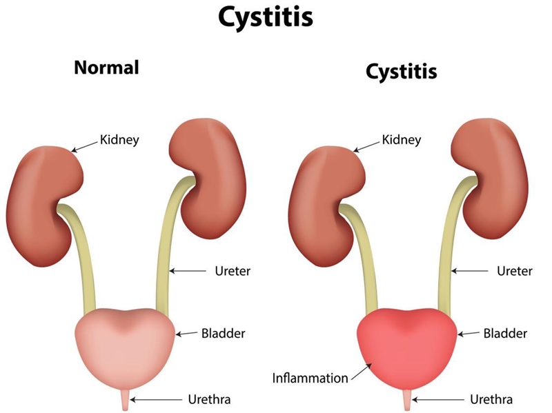 Cystitis is an inflammation of the bladder usually caused by an ascending organism-example-1