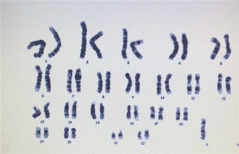 What is wrong with this person's karyotype-example-1