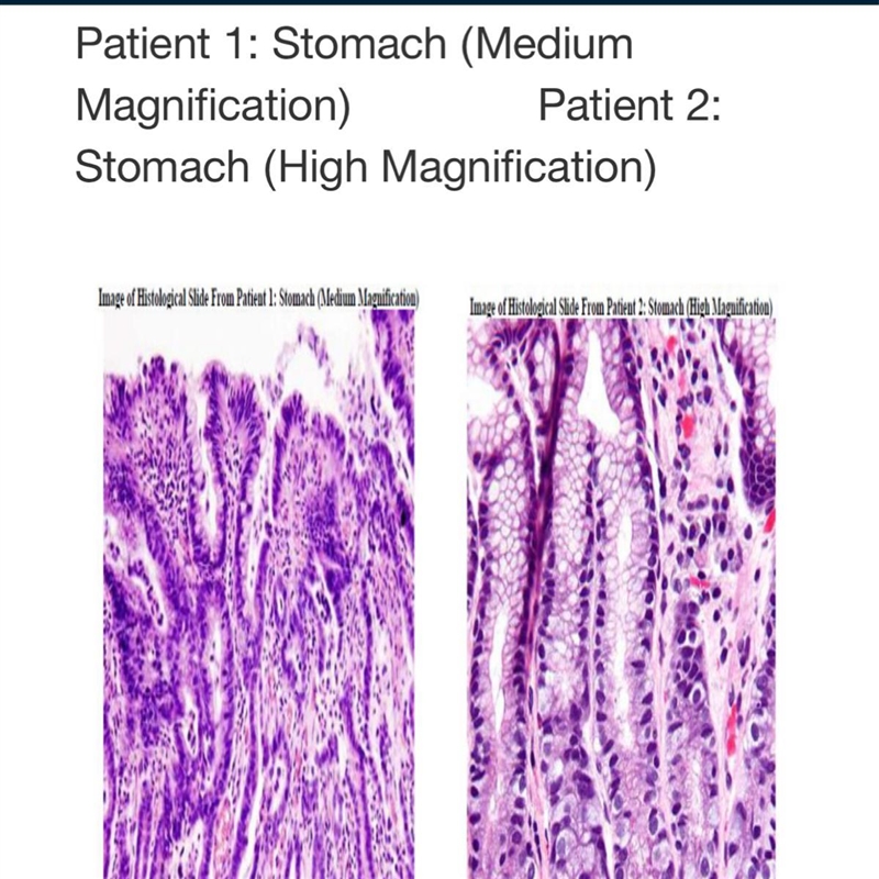 Which patient did you say had cancer and WHY did you pick that one? Help plis-example-1