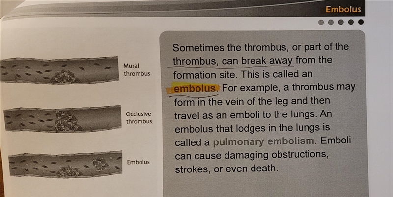 An embolus can cause which of the following?-example-1