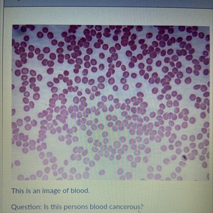 This is an image of blood. Question: Is this persons blood cancerous?-example-1