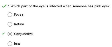 Which part of the eye is infected when someone has pink eye?-example-1