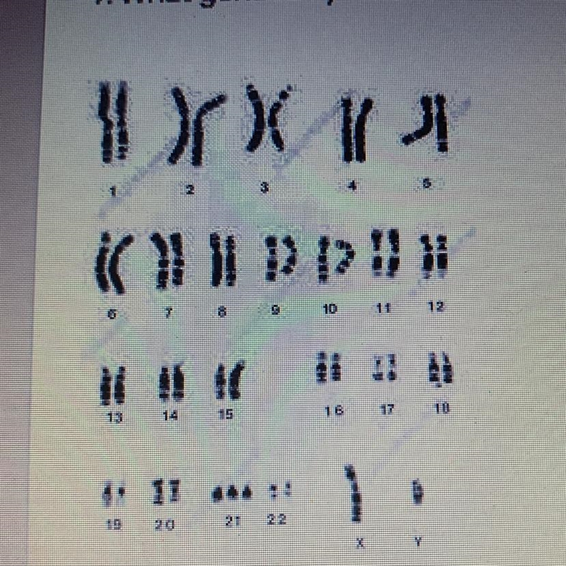 9. What genetic syndrome is shown in this picture?*-example-1