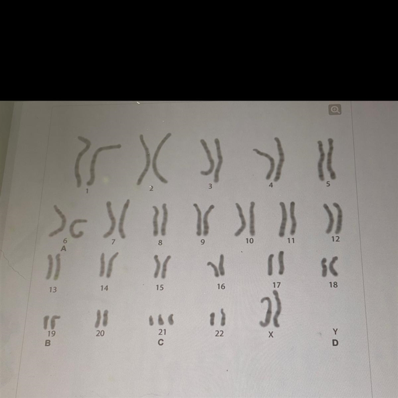 Which part of the karyotype reveals a genetic abnormality? A. A В. В C. С D. D plzzz-example-1