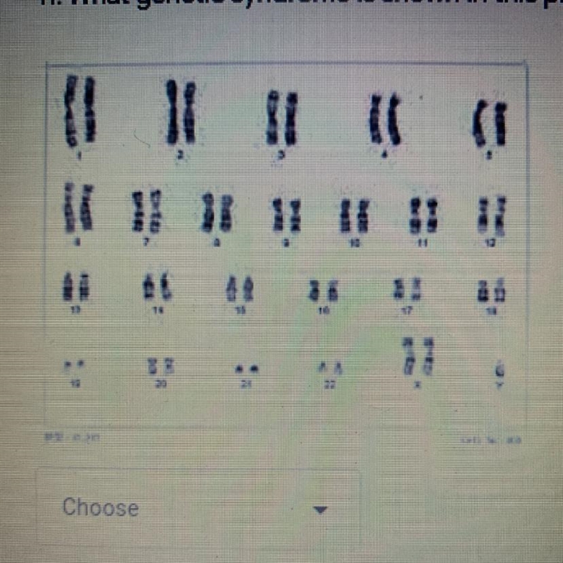 11. What genetic syndrome is shown in this picture?*-example-1