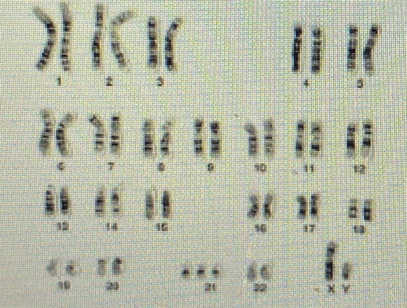 1. Patient c: Using the karyotype below and the chart from the last screen: A. Determine-example-1