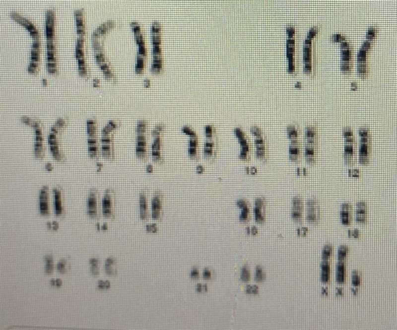 1. Patient B: Using the karyotype below and the chart from the last screen: A. Determine-example-1