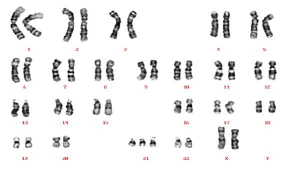 What is the sex of the person in this Karyotype?-example-1