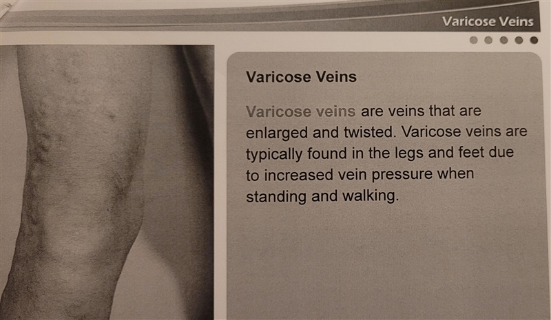 Which of the following people is most likely to develop varicose veins?-example-3