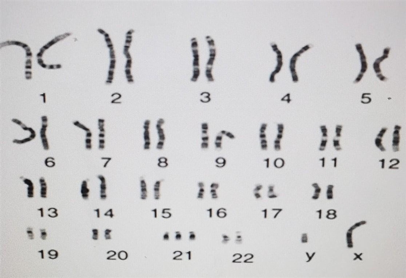 The person whose karyotype is shown below which has which disorder?​-example-1