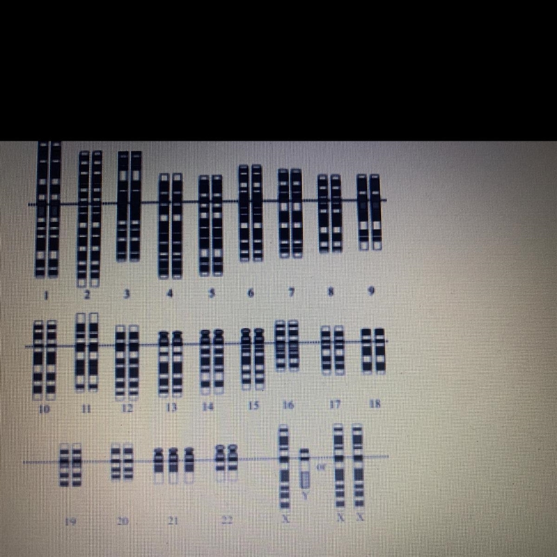 Use the following Karyotype to identify any genetic abnormalities in the subject. A-example-1