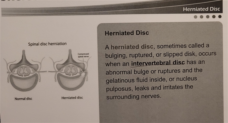 A herniated disc is also sometimes referred to as which of the following?-example-2