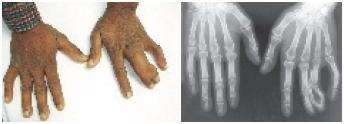 The photos shown below illustrate a case of synpolydactyly, a genetic abnormality-example-1