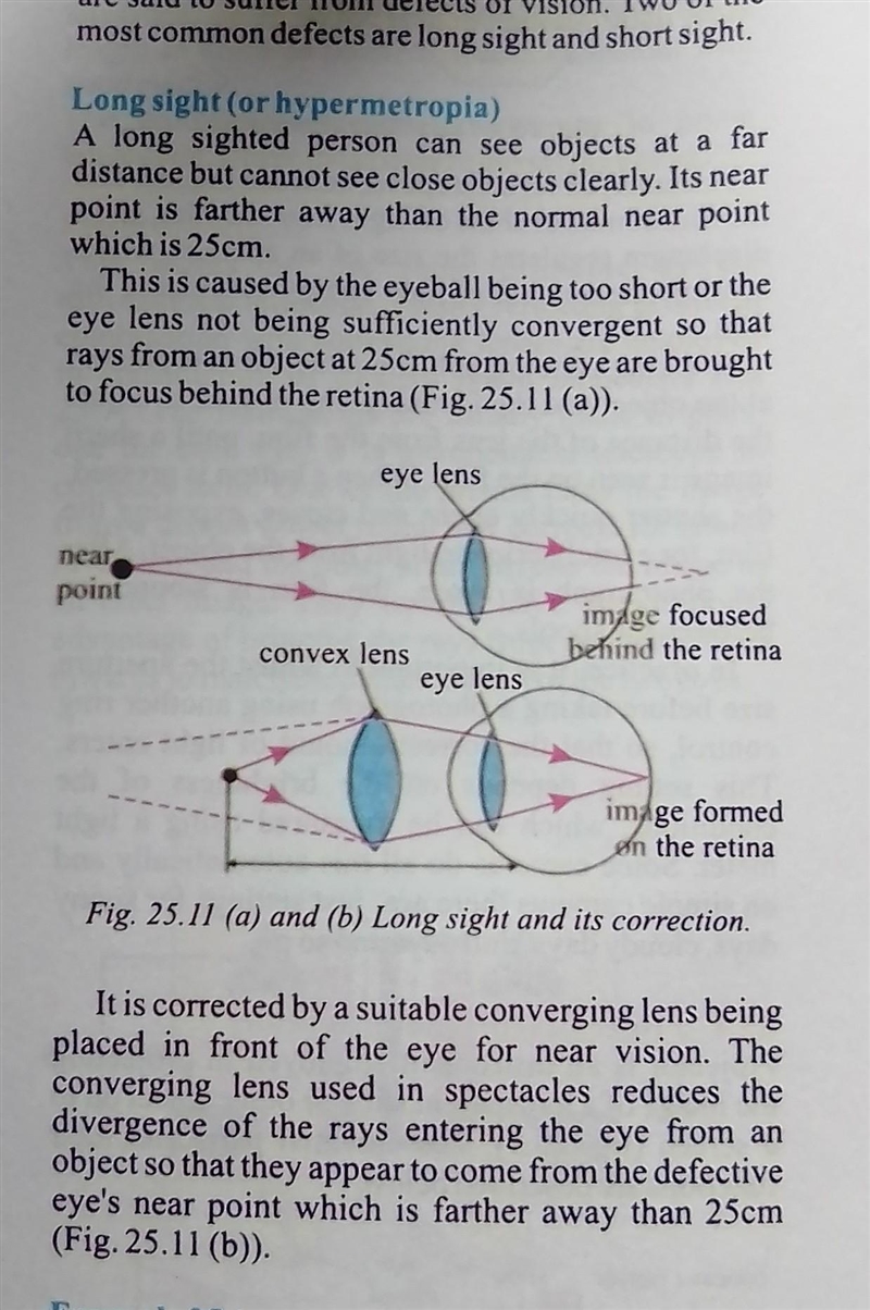 What is myopia and hypermetropia?​-example-1