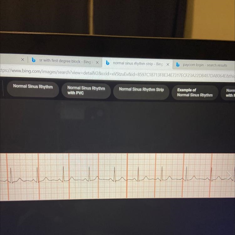 Is this normal sinus rhythm-example-1