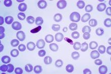 What is the causative agent of malaria​-example-1