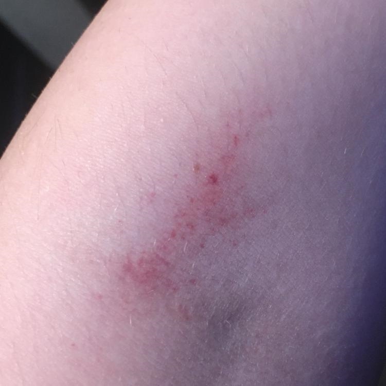 What is this on my arm? I’m concerned-example-1