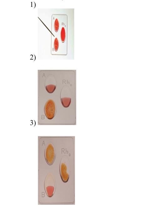 Using the slides below determine the blood type of these individuals- white means-example-1