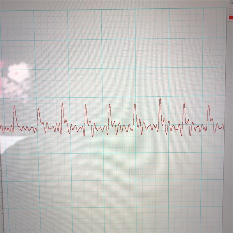 Is this normal heart rhythms? The amplitude of the QRS is slightly different but I-example-1