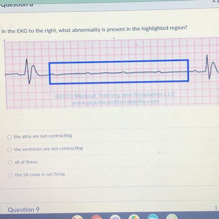 In the EKG to the right, what abnormality is present in the highlighted region?-example-1