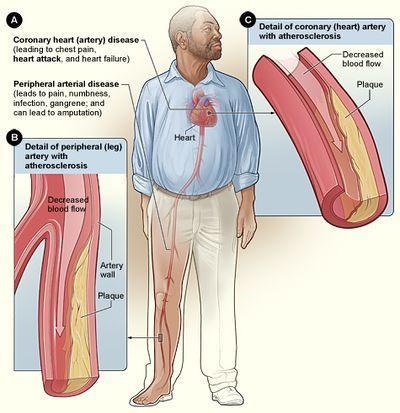 Discuss how smoking is a risk factor for the development of atherosclerosis-example-1