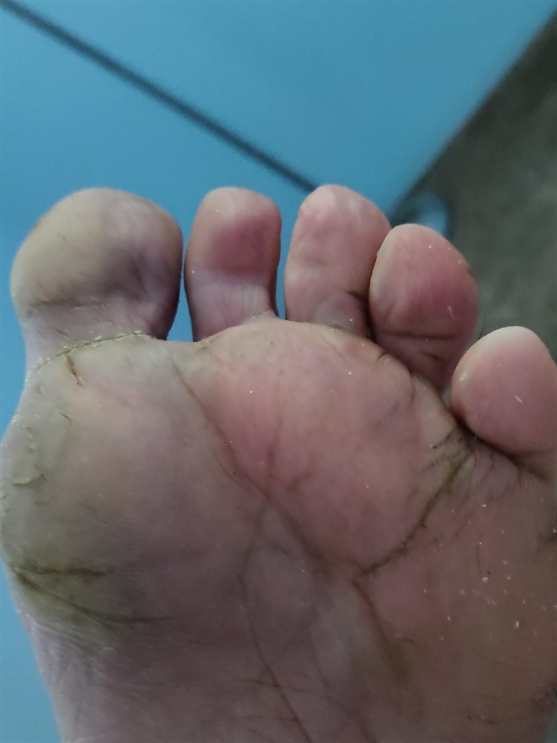 Does this picture on the foot look like it might be gangrene? ​-example-1