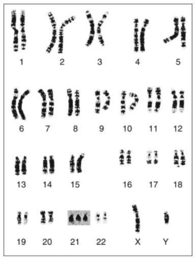 Answer quickly i need it now The picture shows the chromosomes of a human. What caused-example-1