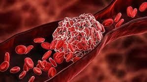 What is blood clot?? and what does it do-example-1