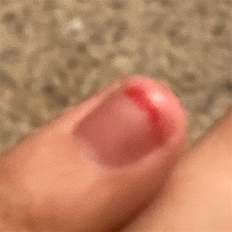 Hello People How Long Will It Take For My Bloody Nail To Heal-example-1