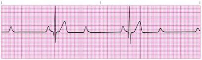 This is my last question so please help!!!!!! What is this rhythm? What is the possible-example-1