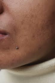 What should i do to get rid of my post pimple/acne scars they look like this-example-1