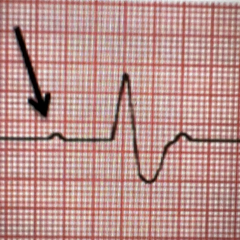 Which statement describes the condition of the heart at the point indicated in the-example-1