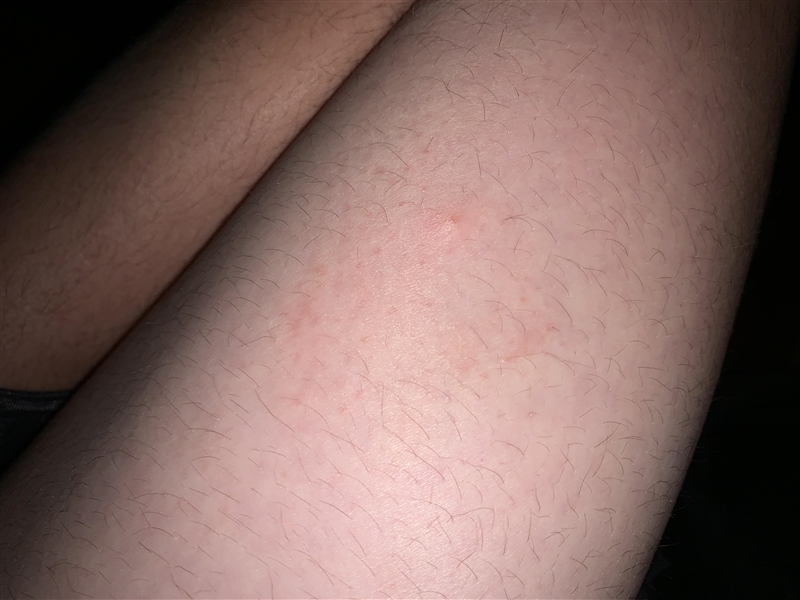 i’ve had this rash on my leg for about 4 months, i’ve done a lot of research and can-example-1