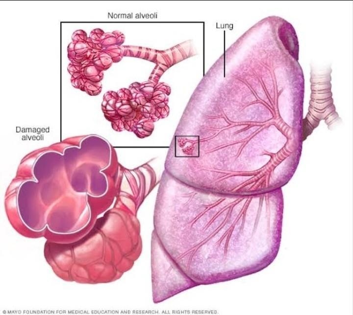 Select the common forms of chronic obstructive pulmonary disease. bronchitis heart-example-1