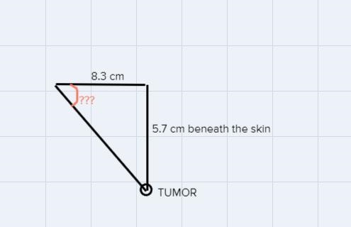 A beam of radiation is to be used to treat a tumor known to be 5.7 cm beneath thepatient-example-1