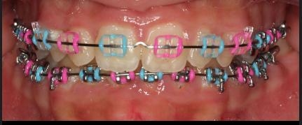 Someone said i should get baby blue or pink braces but what if i get both colors-example-1