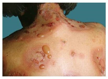 You are a physician in a clinic. You see a patient suffering from skin blistering-example-1