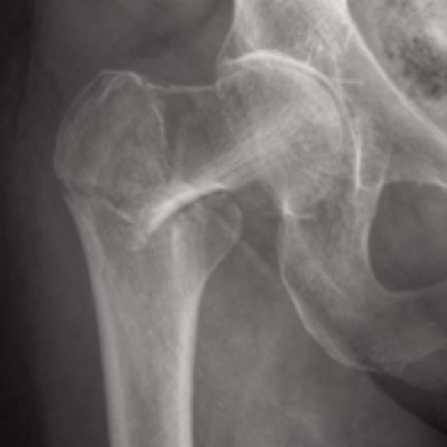 What type of fracture would this be (femur, pelvis)-example-1