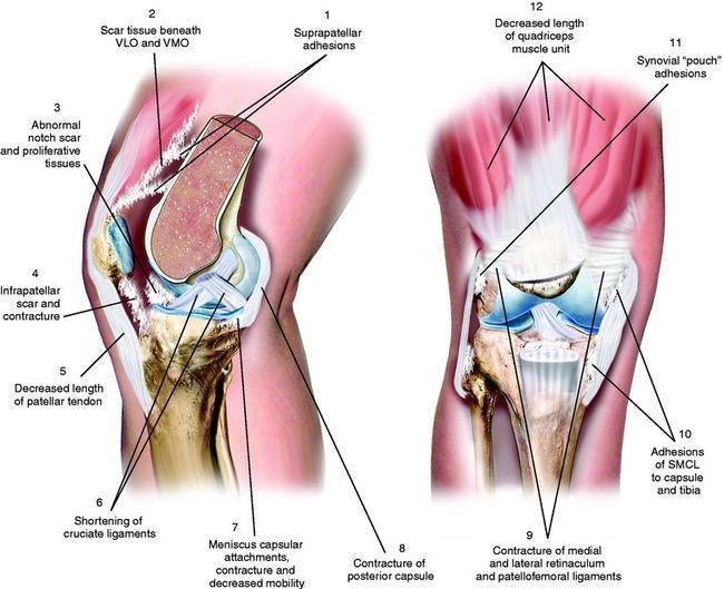 Fibrosis is a muscle injury that is caused by excessive scar tissue on the muscle-example-1