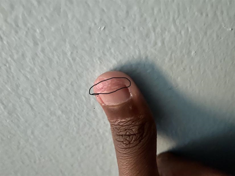 Can someone tell me what part of the fingernail this is , this really hurts-example-1