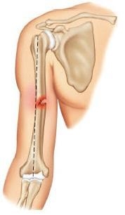 What bone fracture is this-example-1