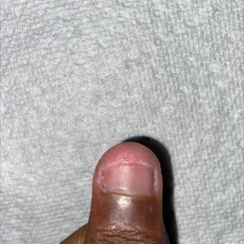 Can someone tell me what part of the fingernail this is , this really hurts-example-1