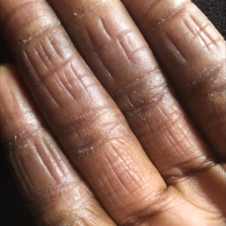 What causes/what is wrinkles on back hands. provide an answer in the text box-example-1