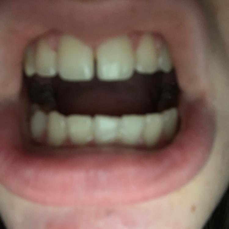 Do my teeth look straight? answer asap-example-1