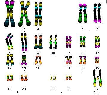 *100 POINTS* Turner syndrome occurs in females who instead of having two X chromosomes-example-1