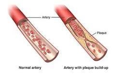 Explain what plaque is (plaque from arteries) and why it is harmful to one's health-example-1