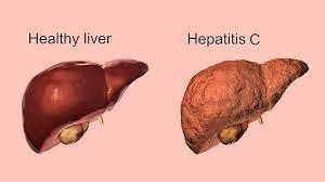 Whats viruses c liver?-example-1