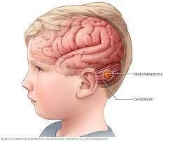 What is brain tumor???-example-1